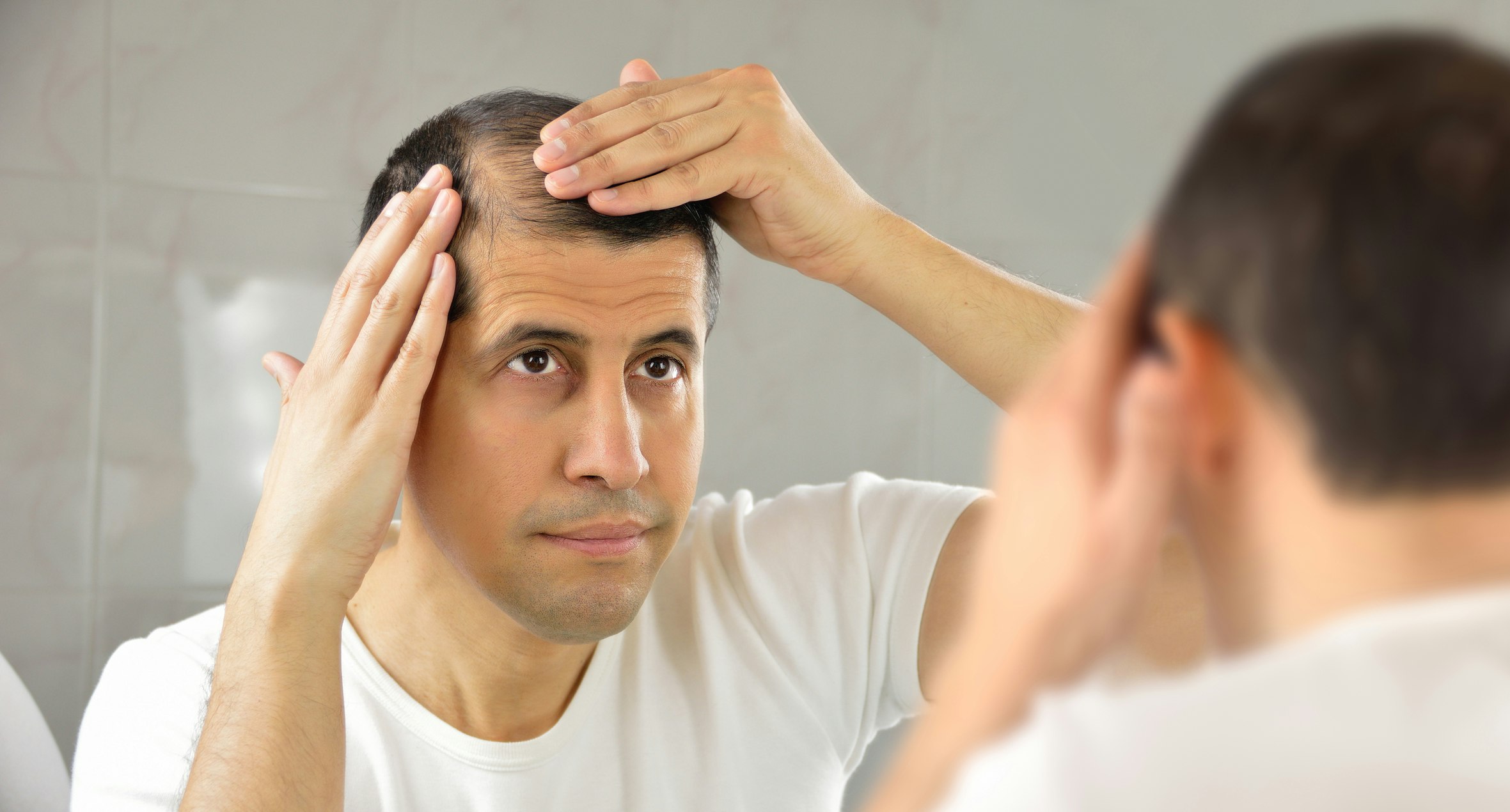 l obésité peut causer la perte de cheveux